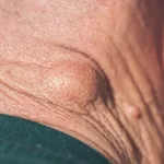 Does Medicare Cover Lipoma Removal?