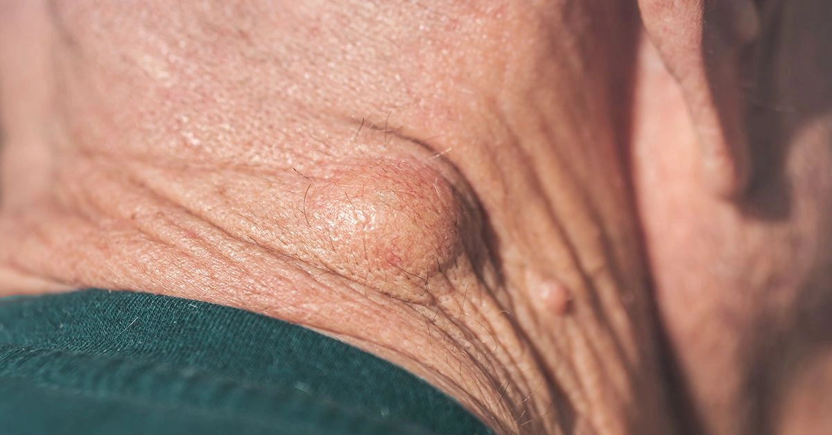 Does Medicare Cover Lipoma Removal?