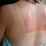 Is This Sunburn Ever Going to Turn Into a Tan?