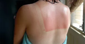 Is This Sunburn Ever Going to Turn Into a Tan?