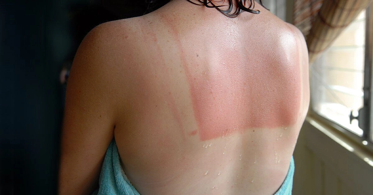 Is This Sunburn Ever Going to Turn Into a Tan?