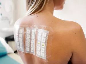 What Is the Patch Test for Contact Dermatitis Allergens? What Is the Patch Test for Contact Dermatitis Allergens?