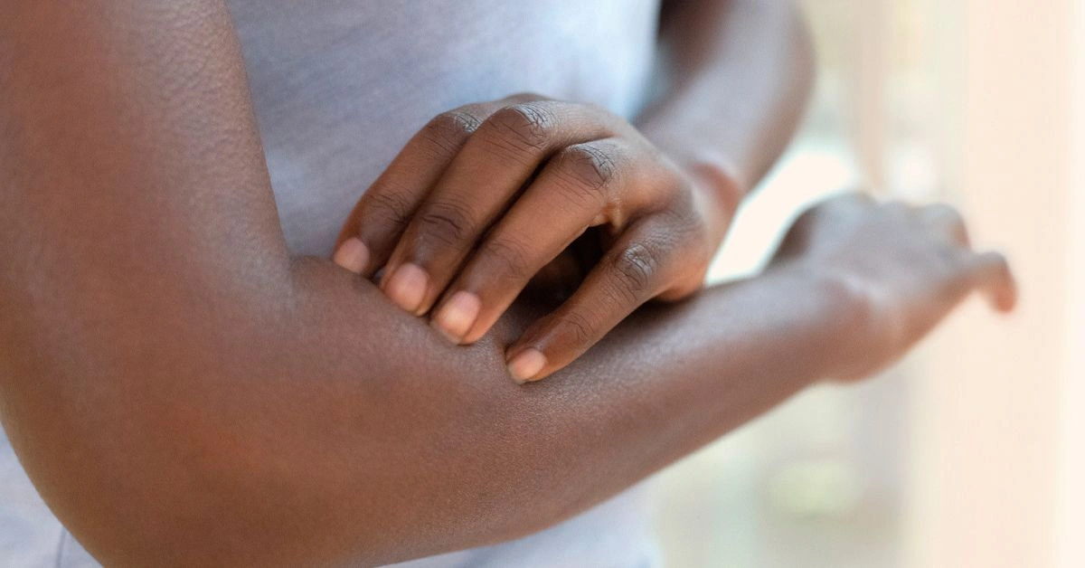 How to Tell the Difference Between Eczema and Rosacea