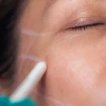 FaceTite: What You Need to Know About This Cosmetic Procedure