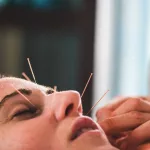 Can Facial Acupuncture Really Make You Look Younger?