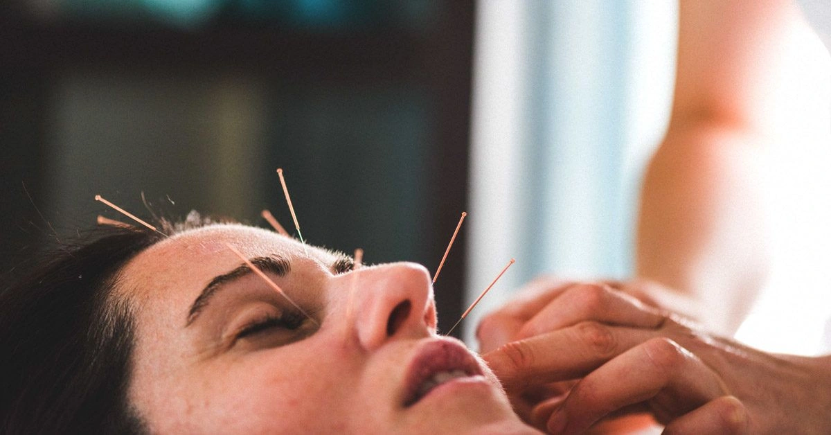 Can Facial Acupuncture Really Make You Look Younger?