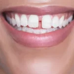 What to Expect from Gingivectomy