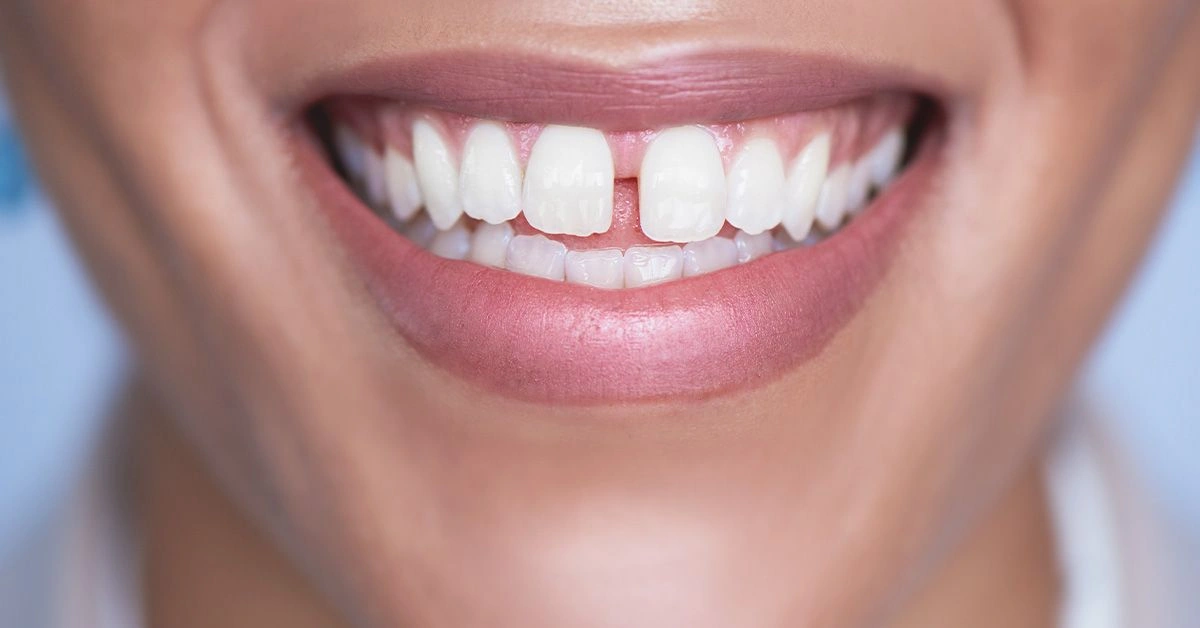 What to Expect from Gingivectomy