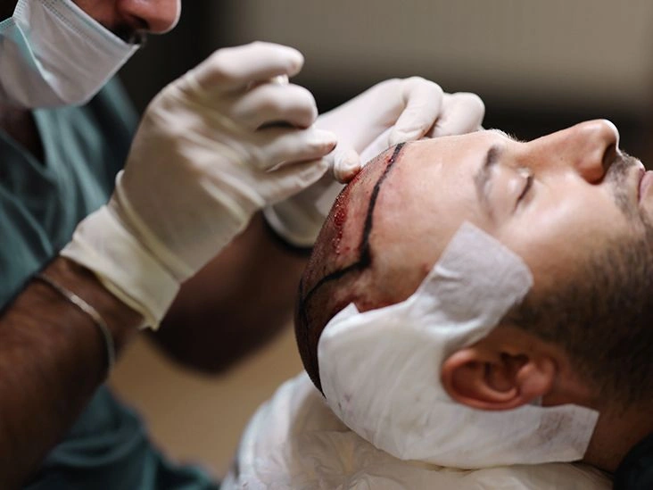 Hair Transplants and Treatment