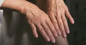 What Causes Bulging Hand Veins?