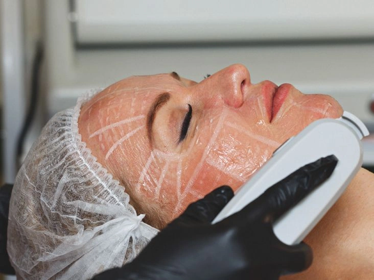Can High-Intensity Focused Ultrasound Treatment Replace Face Lifts?