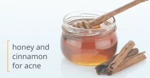Can Honey and Cinnamon Treat Acne?
