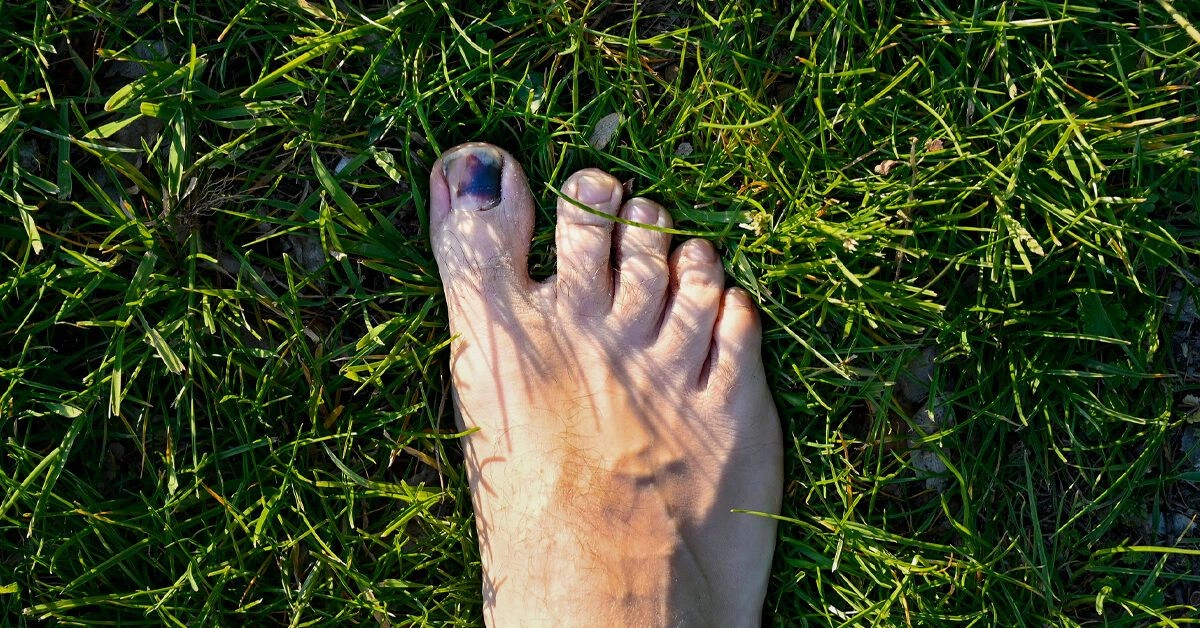How Long Does It Take for a Toenail to Grow Back?