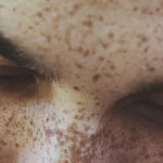 Freckles: Remedies, Causes, and More Freckles: Remedies, Causes, and More
