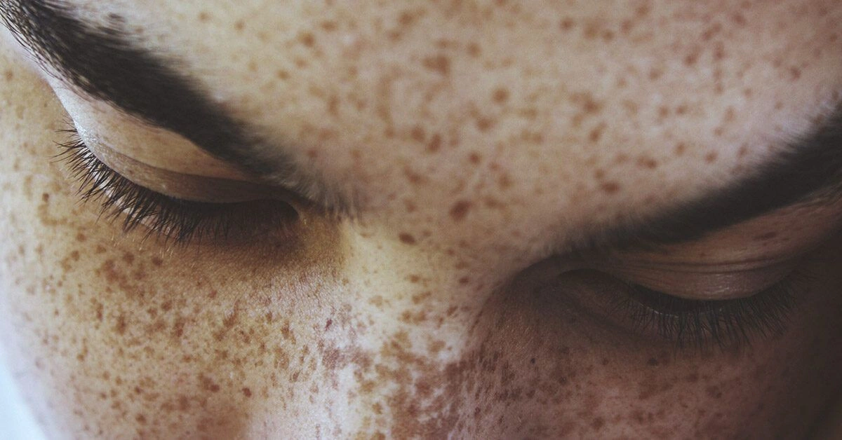 Freckles: Remedies, Causes, and More