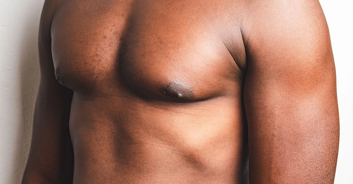 How to Reduce the Appearance of 'Man Boobs' with Exercise and Diet