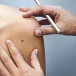 Everything You Should Know About Mole Removal