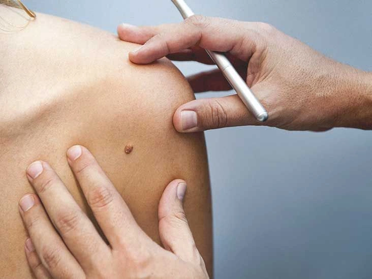Everything You Should Know About Mole Removal