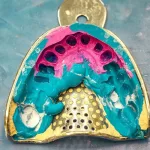 Implant Vs Bridge: Which Is Right for You?