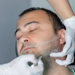 All About Jaw Fillers