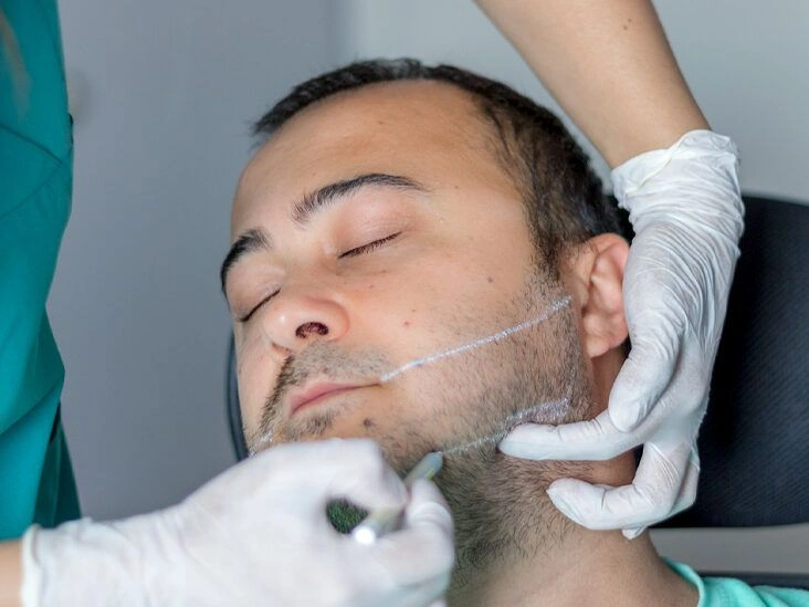 All About Jaw Fillers