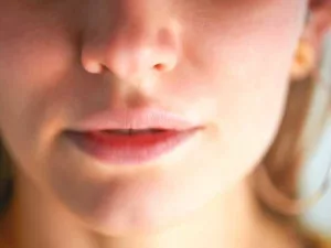 Juvederm: Hyaluronic Acid Dermal Filler