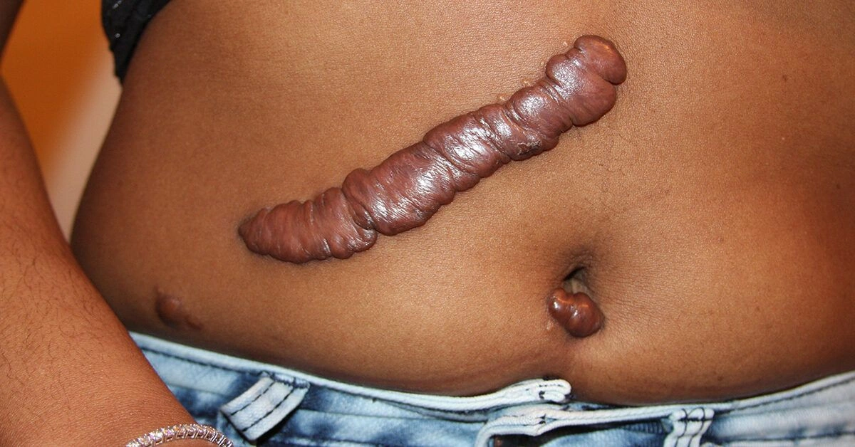 Hypertrophic Scars and Keloids: Similarities and Differences