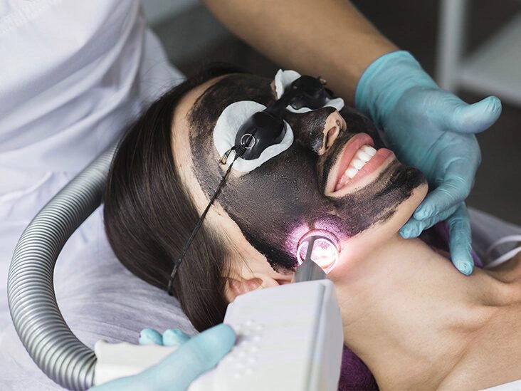 Everything You Need to Know About a Laser Carbon Peel