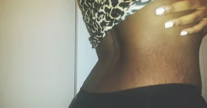 Laser Stretch Mark Removal Cost & Pricing Guide