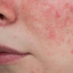 Malar (Butterfly) Rash: Is It Lupus or Rosacea? Malar (Butterfly) Rash: Is It Lupus or Rosacea?