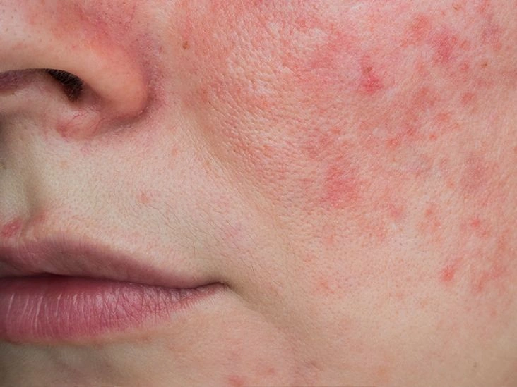 Malar (Butterfly) Rash: Is It Lupus or Rosacea?