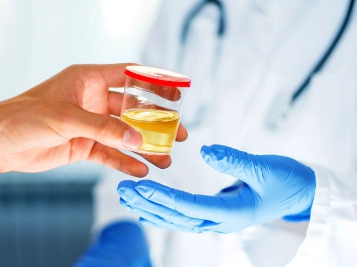 What to Know About a Microalbuminuria Test