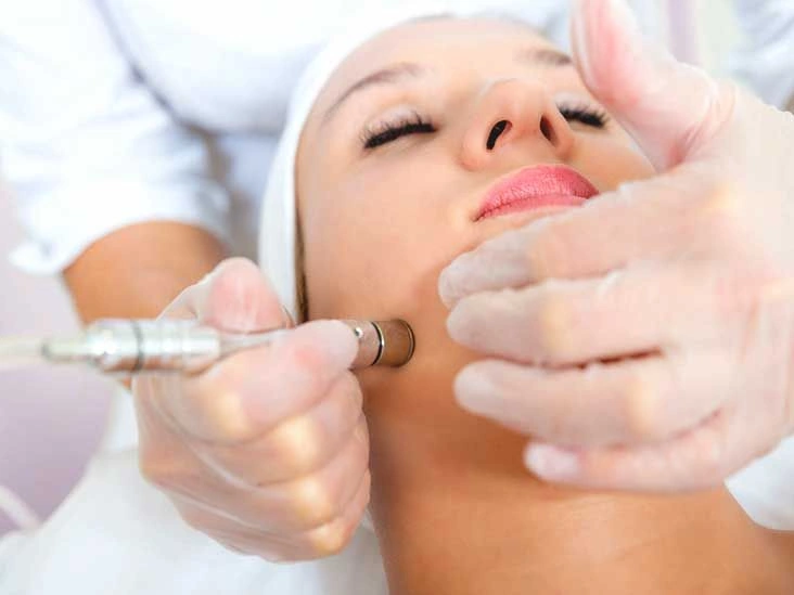 What Is Microdermabrasion?