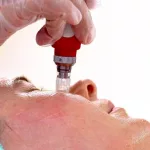 Microneedling Under Eyes Benefits & Safety