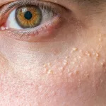 Milium Cysts in Adults and Babies Milium Cysts in Adults and Babies