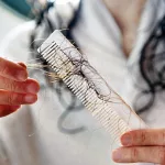 Does the Mirena IUD Cause Hair Loss?