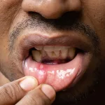 Mouth Sores: Symptoms, Treatment, and Prevention