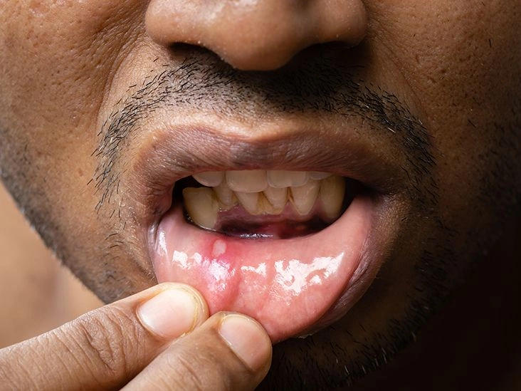 Mouth Sores: Symptoms, Treatment, and Prevention