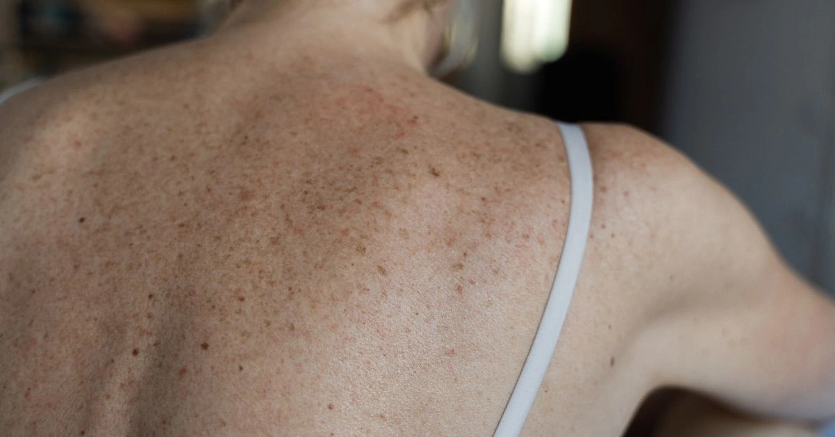 Does Shingles Follow Nerve Pathways?