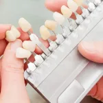 No Prep Veneers: Quick Cosmetic Smile Fix