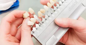 What Are No-Prep Veneers?