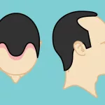 What Is the Norwood Scale?