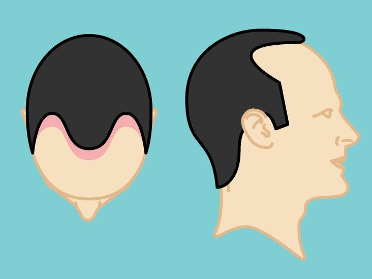 What Is the Norwood Scale?