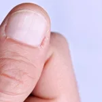 Onychauxis: Thickened Nail Causes & Care