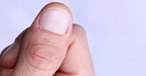 What Is Onychauxis and How Is It Treated? What Is Onychauxis and How Is It Treated?