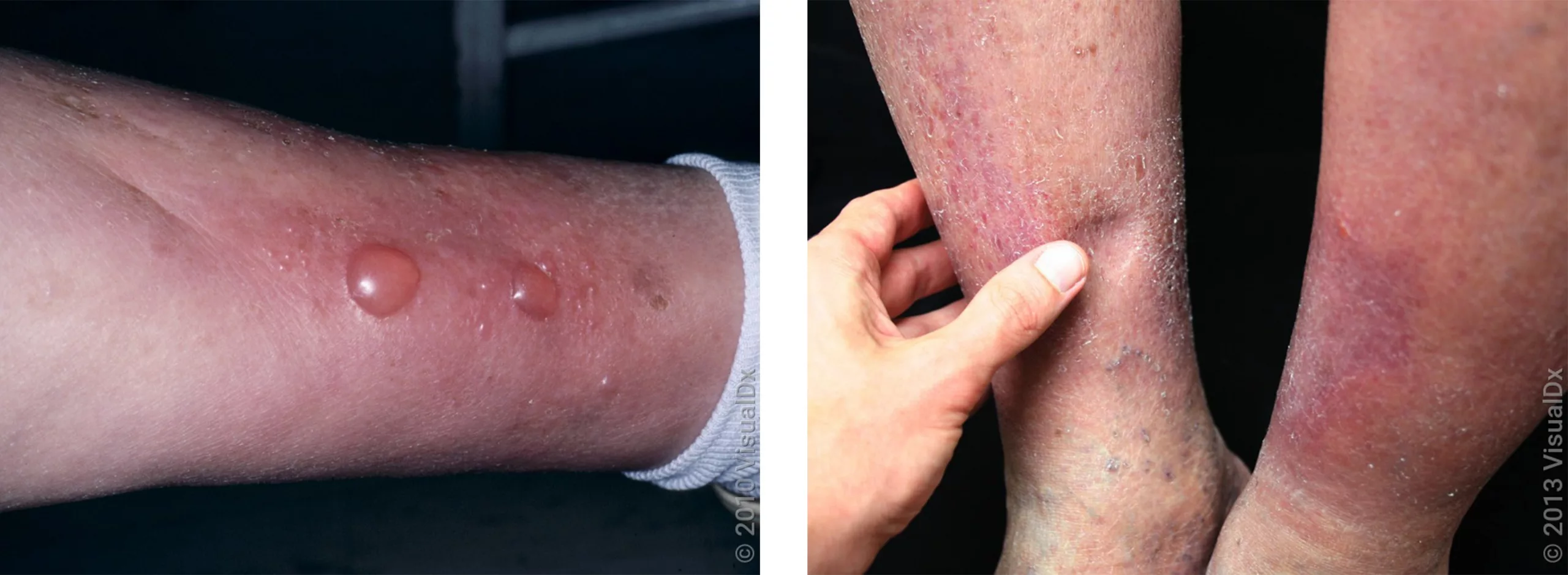 Pictures of Edema Blisters: What They Really Look Like (And Why It Matters!)
