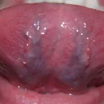 Pictures of Veins Under Tongue: What’s Actually Going On? Pictures of Veins Under Tongue: What’s Actually Going On?