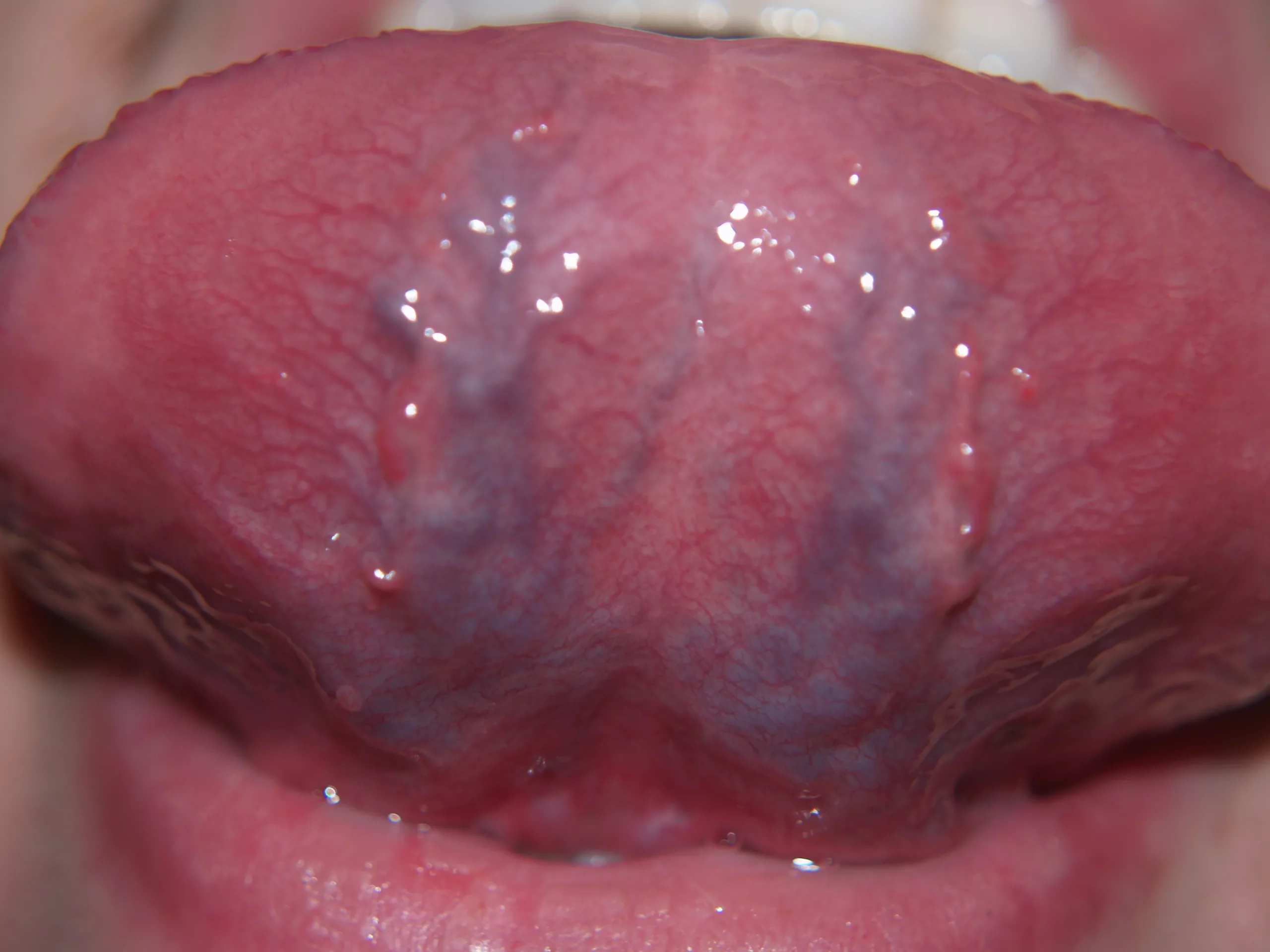 Pictures of Veins Under Tongue: What’s Actually Going On?