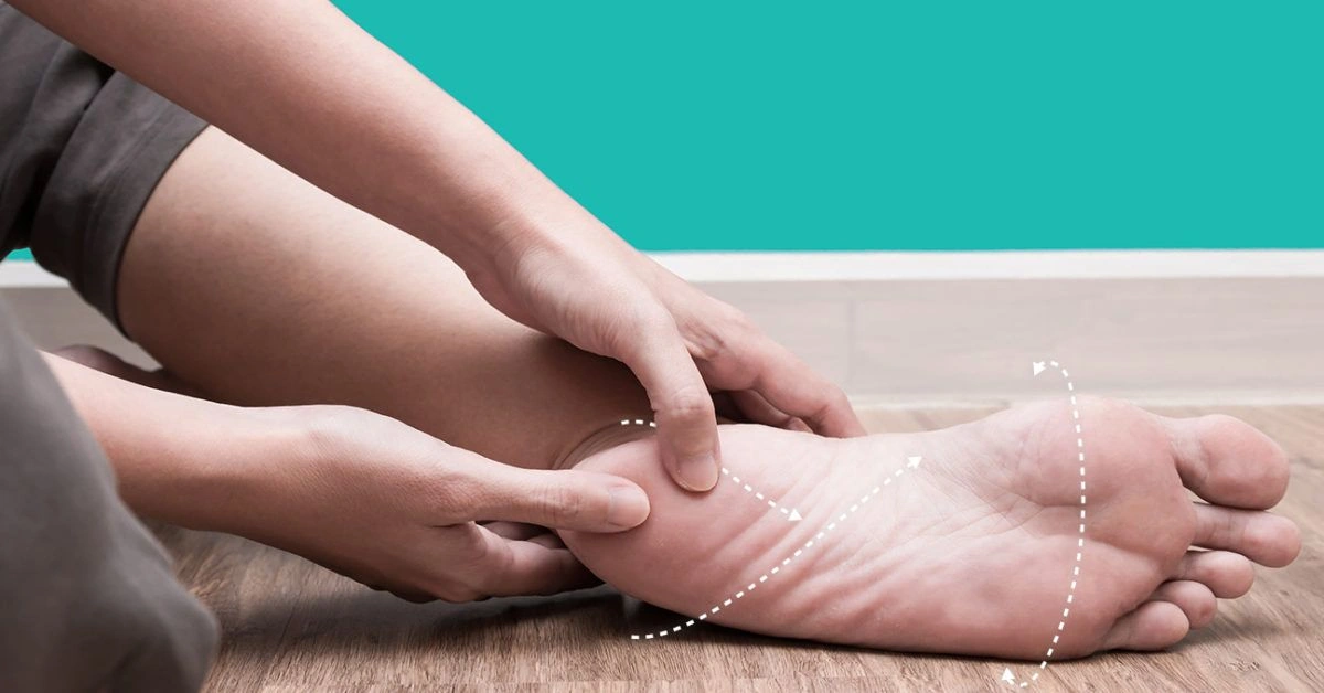 Taping: The Secret Weapon for Managing Plantar Fasciitis