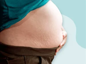 What Is a B Belly During Pregnancy and Why Does It Happen?